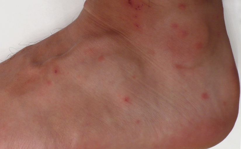 A Lesson Chiggers Taught Me